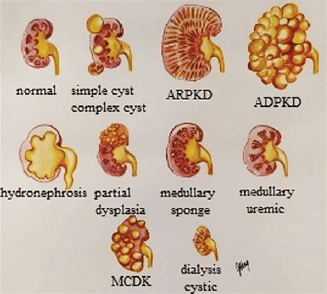 medullary cystic kidney disease causes.